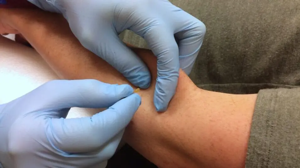 Dry Needling vs. Acupuncture by Dr. Sarah Crawford